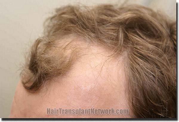 Hair restoration procedure results