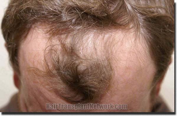 Hair restoration procedure results