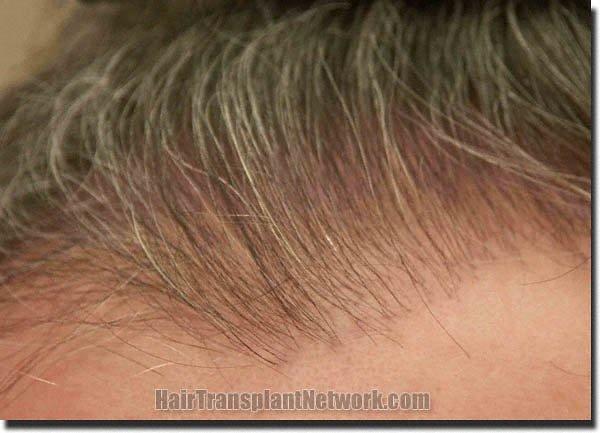 Hair restoration procedure results