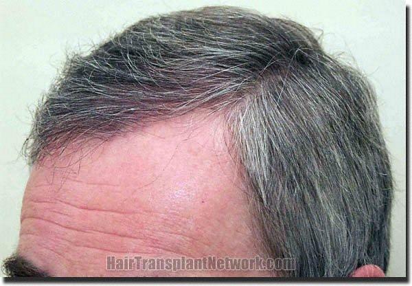 Hair restoration procedure results