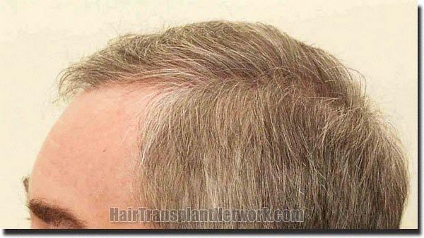 Hair restoration procedure results