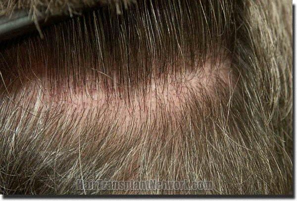 Hair restoration procedure results