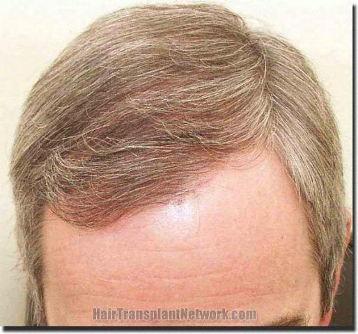 Hair restoration procedure results