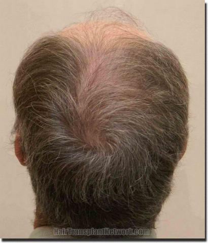 Hair restoration procedure results