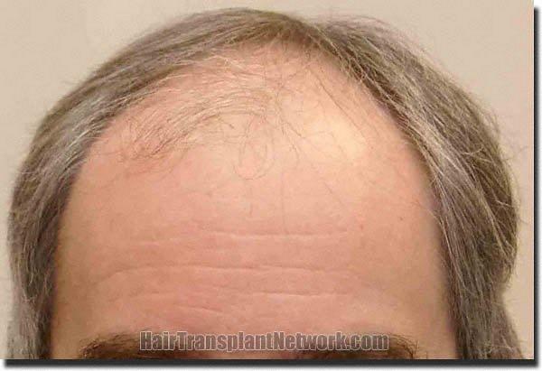 Hair restoration procedure results