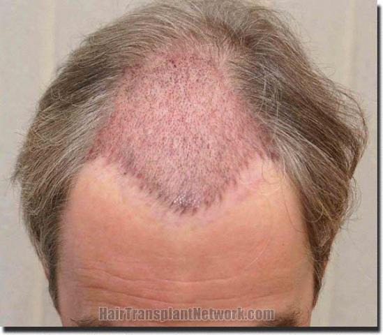 Hair restoration procedure results