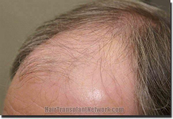 Hair restoration procedure results