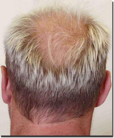 Hair restoration procedure results