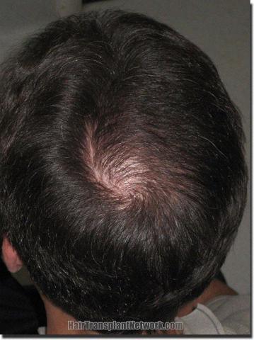 Hair restoration procedure results