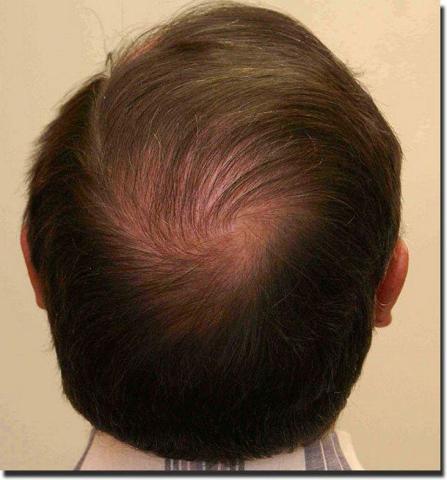 Hair restoration procedure results