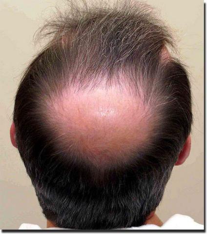 Hair restoration procedure results