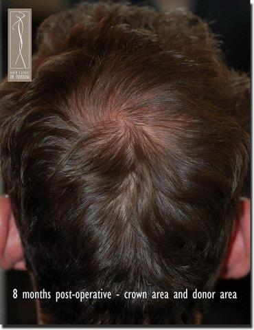 Hair restoration procedure results