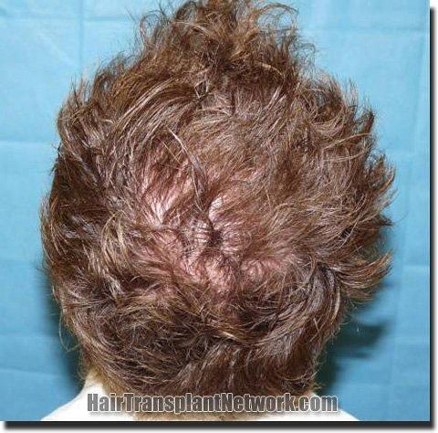 Hair restoration procedure results