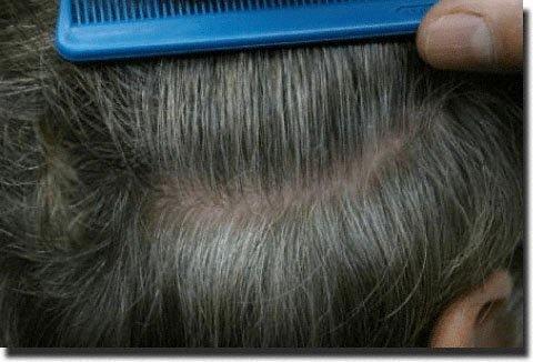 Hair restoration procedure results