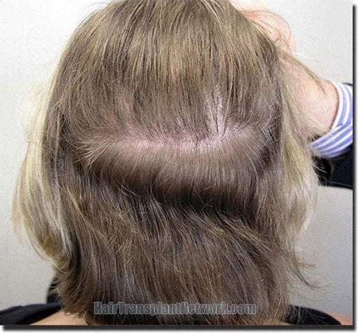 Hair restoration procedure results