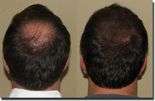 Hair restoration procedure results