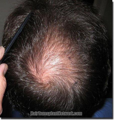 Hair restoration procedure results