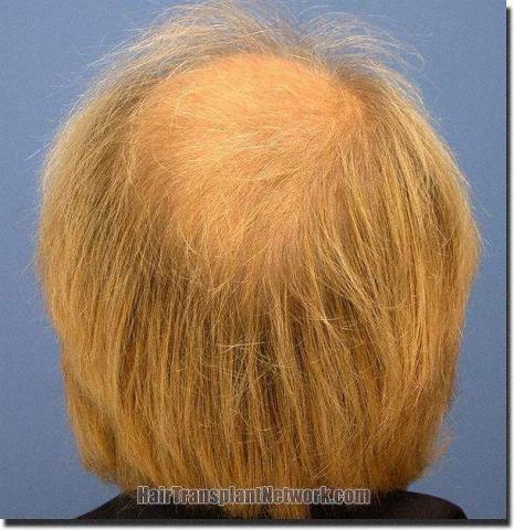 Hair restoration procedure results