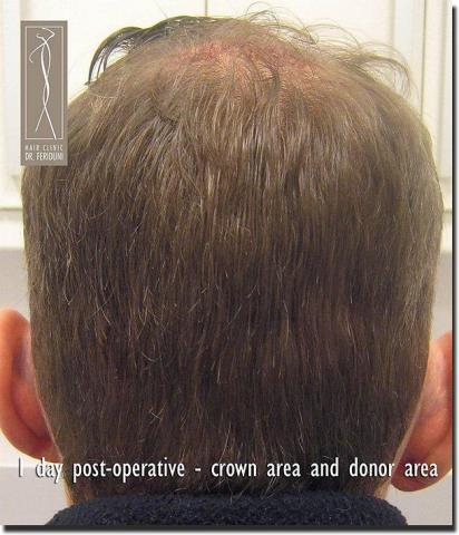 Hair restoration procedure results