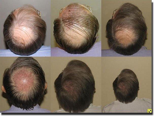 Hair restoration procedure results