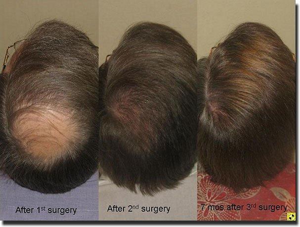 Hair restoration procedure results