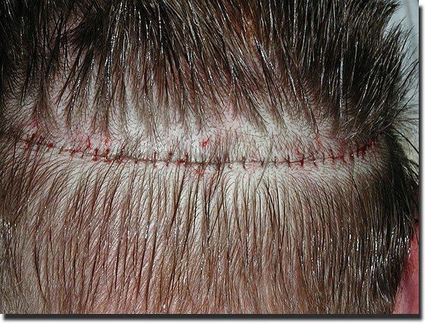 Hair restoration procedure results