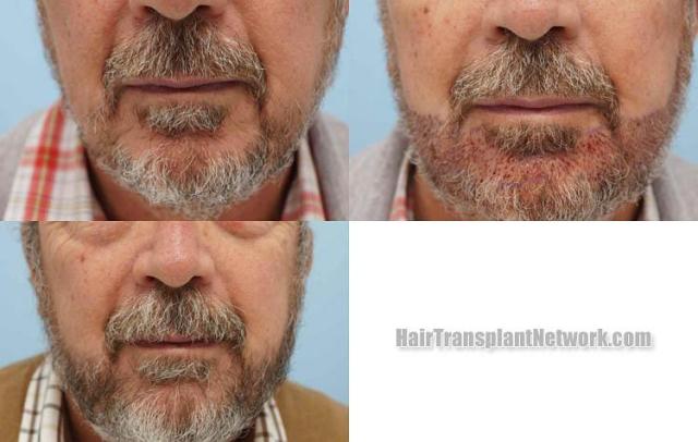 Front view - Before and after beard transplantation surgery