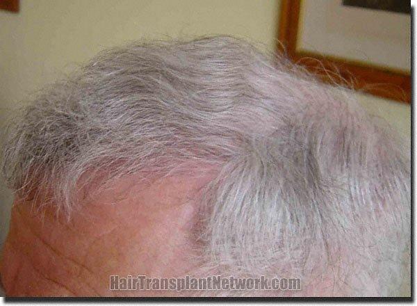 Hair restoration procedure results