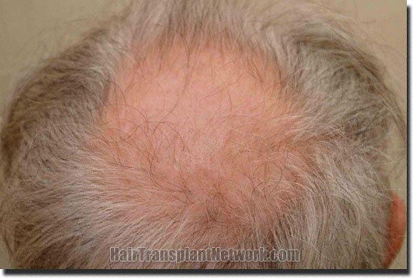 Hair restoration procedure results