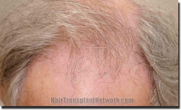 Hair restoration procedure results