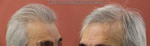 Hair transplantation surgery before and after images