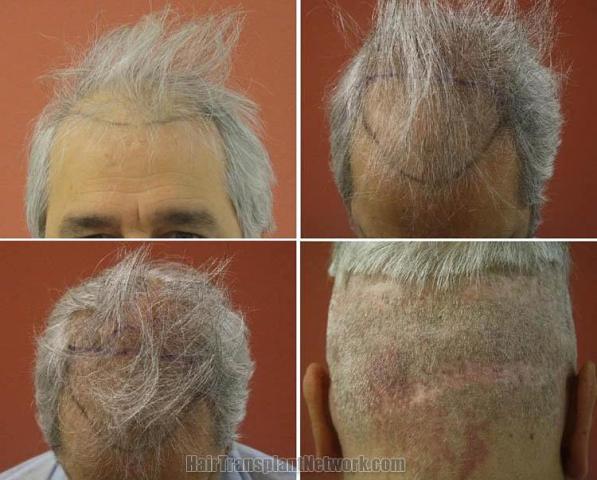 Hair transplantation surgery before and after photos