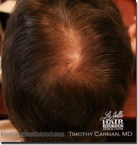 Hair restoration procedure results