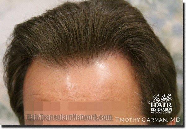 Hair restoration procedure results