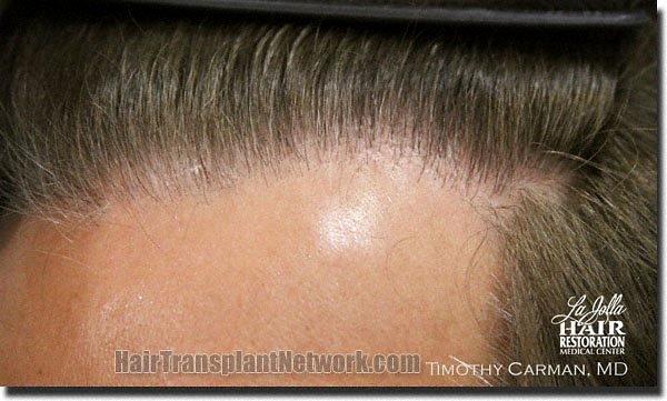 Hair restoration procedure results