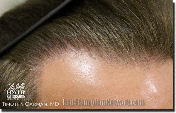 Hair restoration procedure results