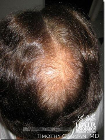 Hair restoration procedure results