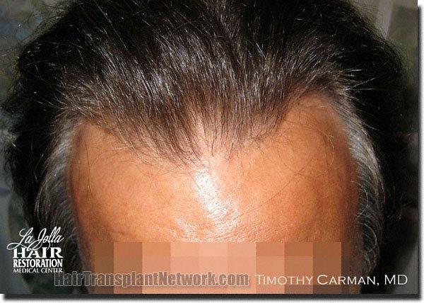 Hair restoration procedure results