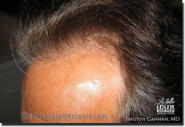 Hair restoration procedure results