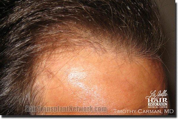 Hair restoration procedure results