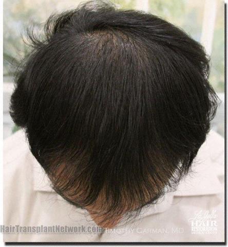 Hair restoration procedure results