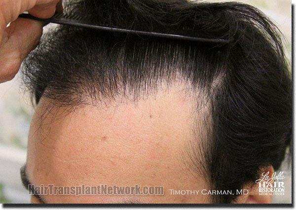 Hair restoration procedure results