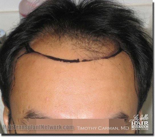 Hair restoration procedure results