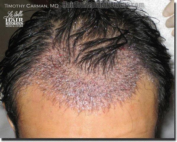 Hair restoration procedure results