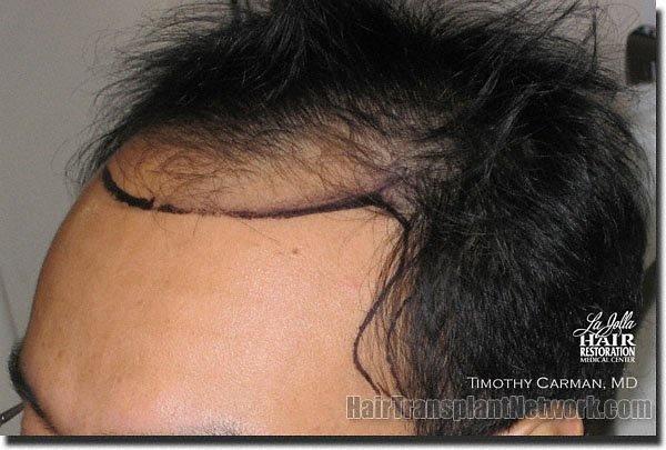 Hair restoration procedure results