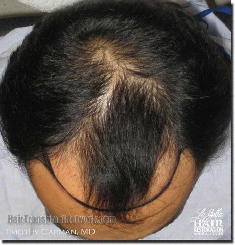 Hair restoration procedure results