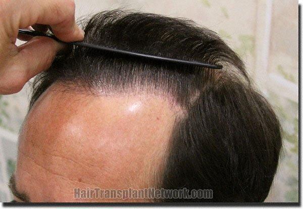 Hair restoration procedure results