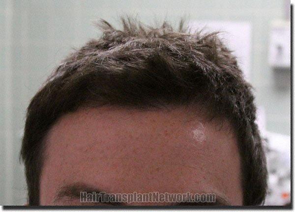 Hair restoration procedure results