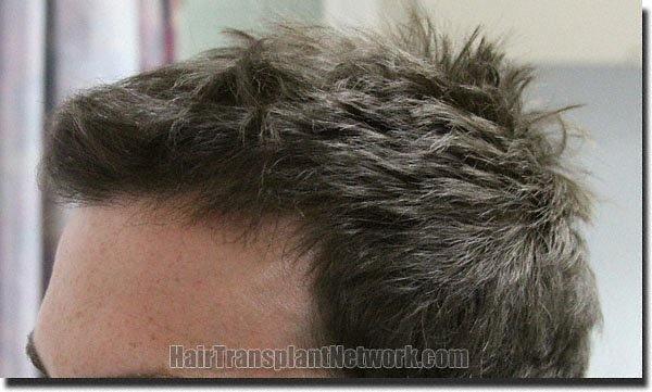 Hair restoration procedure results