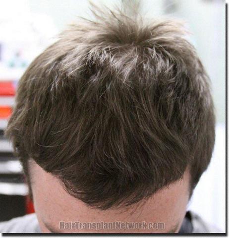 Hair restoration procedure results